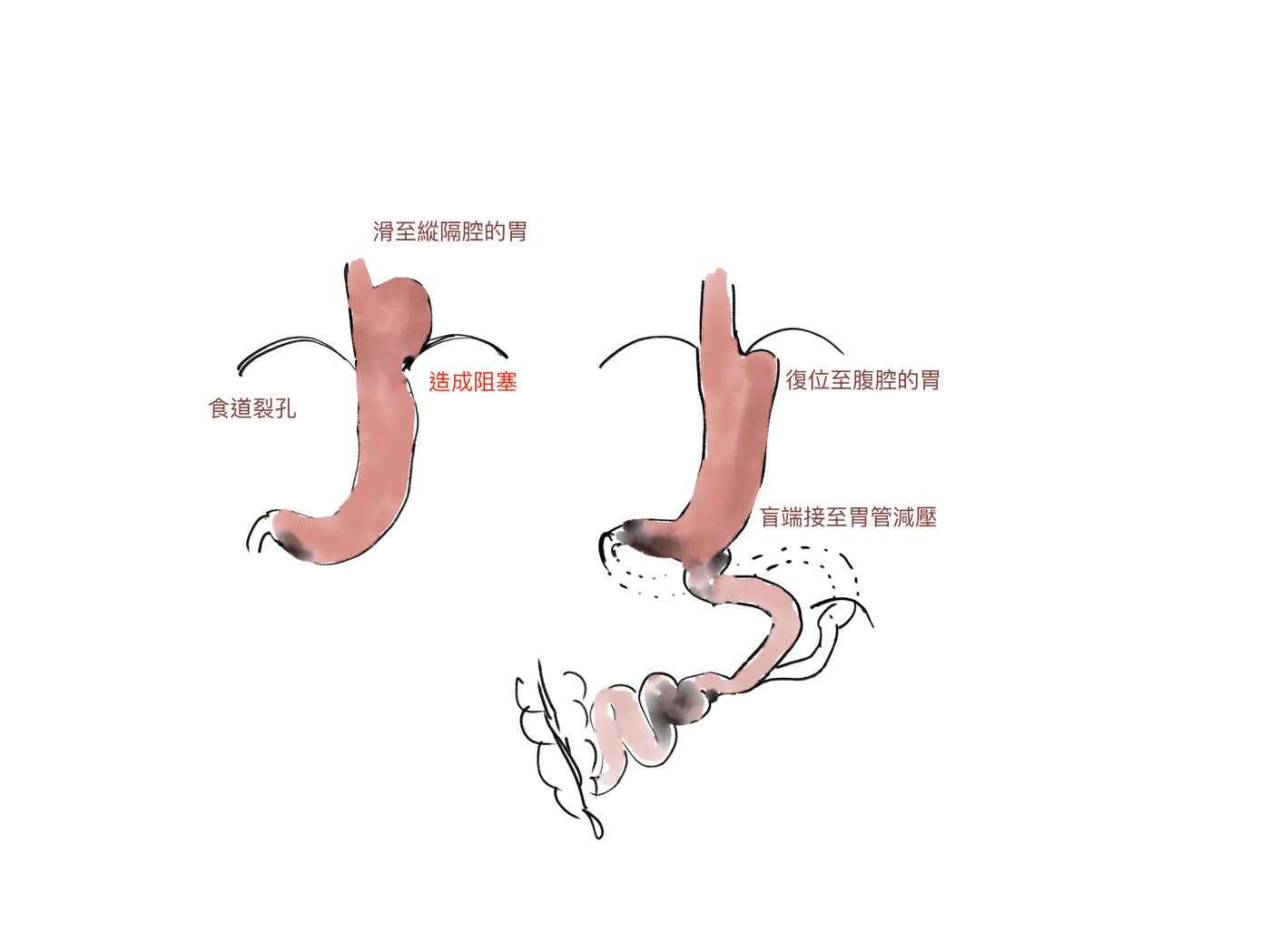 手術示意圖：左為食道裂孔疝氣造成阻塞，右為疝氣復位後接轉位雙通道減壓 | Surgical diagram: left shows hiatal hernia obstruction, right shows post-repair transit bipartition for decompression