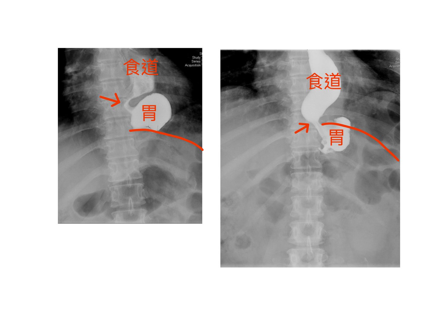 上消化道攝影（UGI）：食道裂孔疝氣復發，胃體滑入縱隔腔 | Upper GI series showing recurrent hiatal hernia with gastric herniation into mediastinum